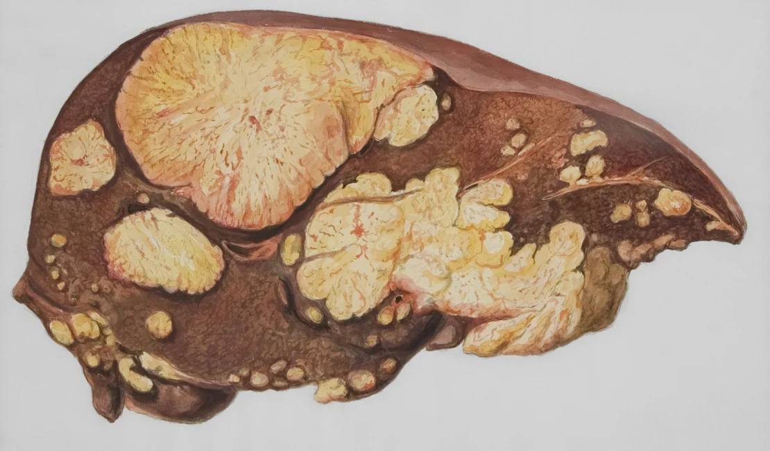 Cancer Symptoms