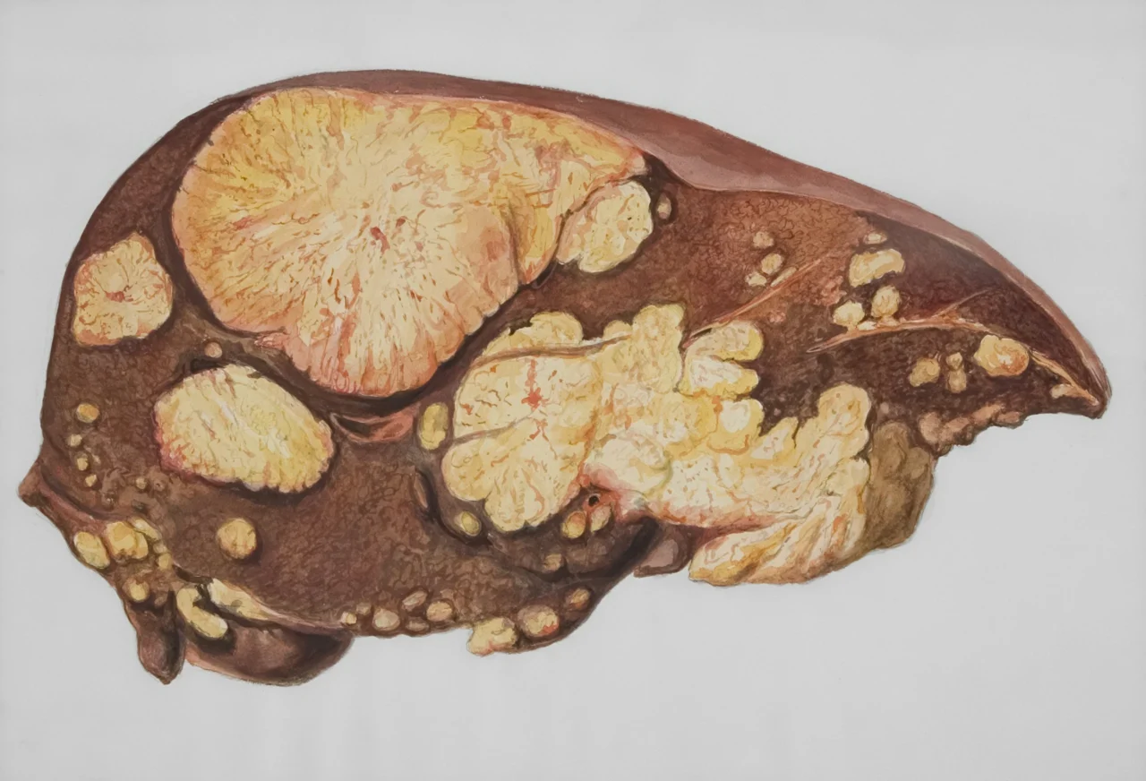 Cancer Symptoms