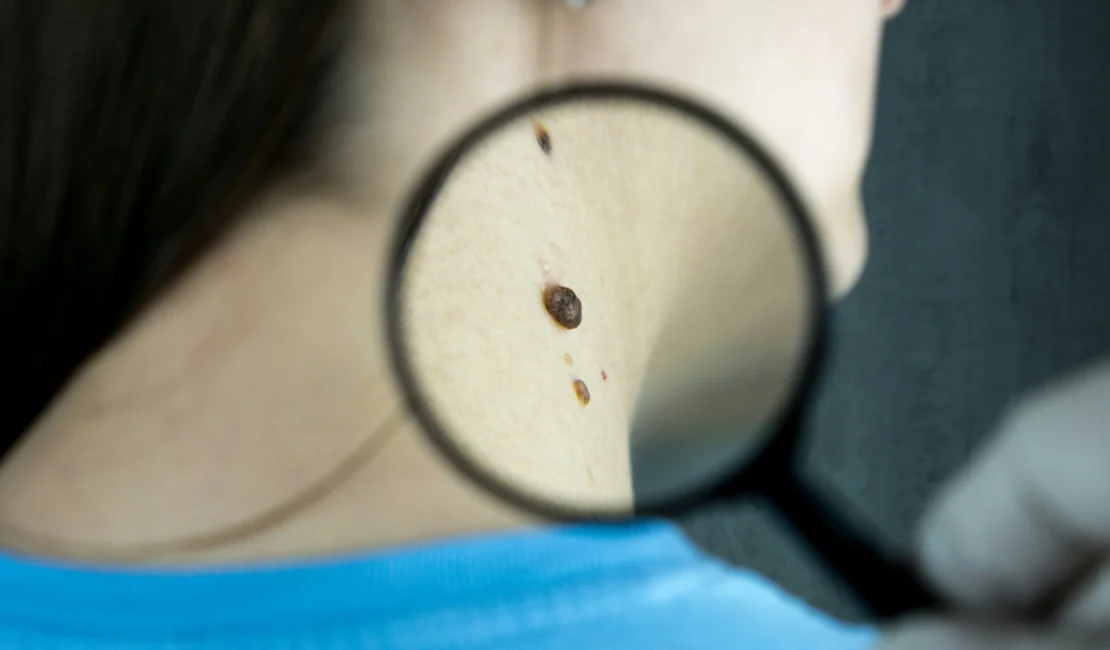 Skin Cancer