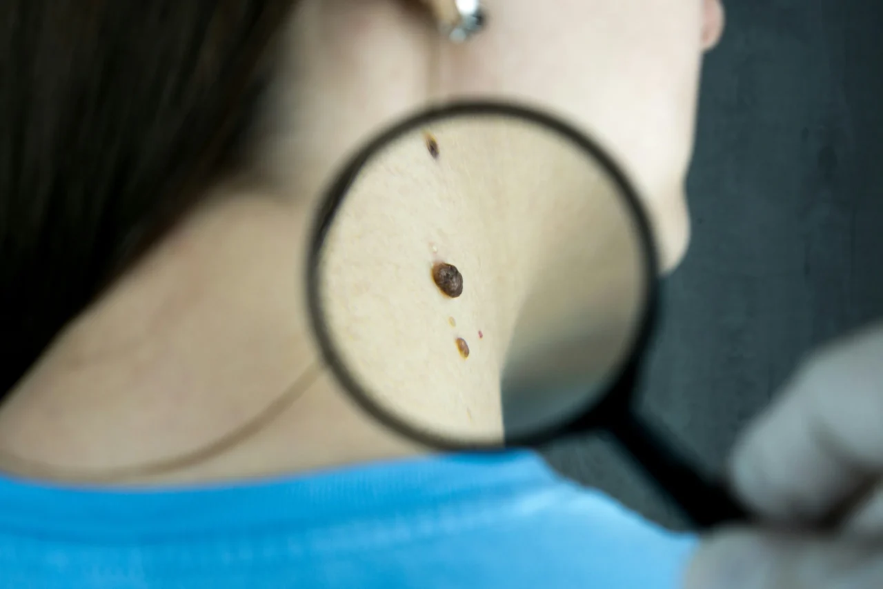 Skin Cancer
