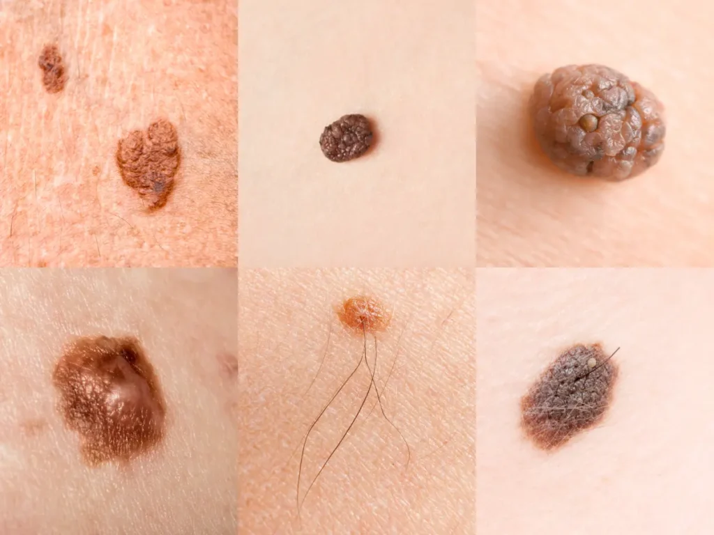 Skin Cancer Types